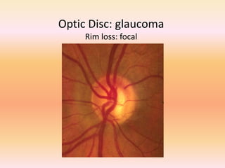 Optic Disc: glaucoma
Rim loss: focal
 
