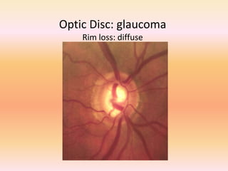 Optic Disc: glaucoma
Rim loss: diffuse
 