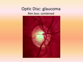 Optic Disc: glaucoma
Rim loss: combined
 
