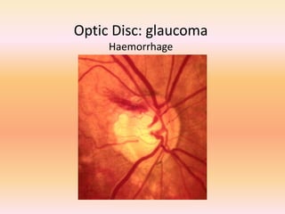 Optic Disc: glaucoma
Haemorrhage
 
