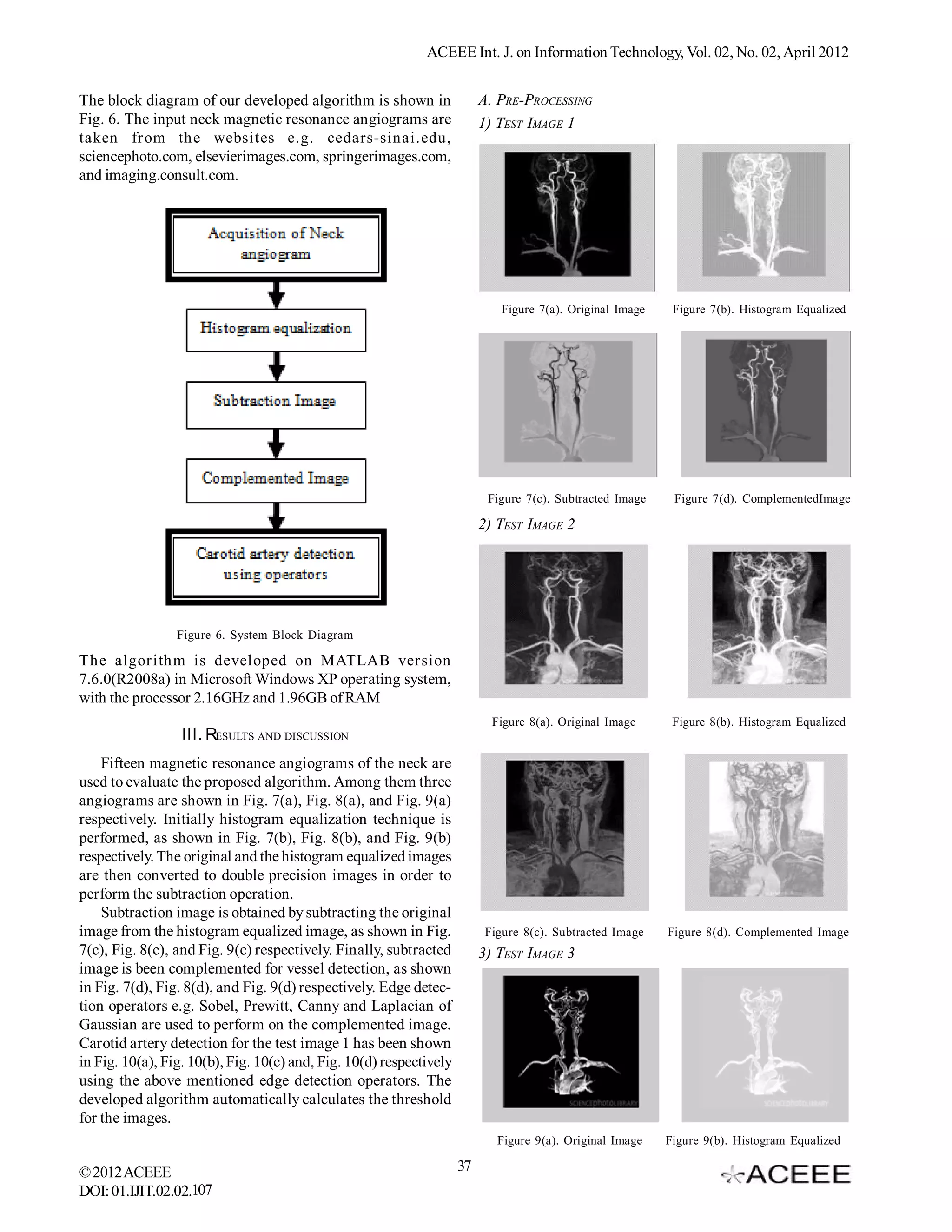 ACEEE Int. J. on Information Technology, Vol. 02, No. 02, April 2012


The block diagram of our developed algorithm is shown in                  A. PRE-PROCESSING
Fig. 6. The input neck magnetic resonance angiograms are                  1) TEST IMAGE 1
taken from the websites e.g. cedars-sinai.edu,
sciencephoto.com, elsevierimages.com, springerimages.com,
and imaging.consult.com.




                                                                              Figure 7(a). Original Image    Figure 7(b). Histogram Equalized




                                                                           Figure 7(c). Subtracted Image     Figure 7(d). ComplementedImage

                                                                          2) TEST IMAGE 2




                 Figure 6. System Block Diagram

The algorithm is developed on MATLAB version
7.6.0(R2008a) in Microsoft Windows XP operating system,
with the processor 2.16GHz and 1.96GB of RAM
                                                                            Figure 8(a). Original Image      Figure 8(b). Histogram Equalized
                  III. RESULTS AND DISCUSSION
    Fifteen magnetic resonance angiograms of the neck are
used to evaluate the proposed algorithm. Among them three
angiograms are shown in Fig. 7(a), Fig. 8(a), and Fig. 9(a)
respectively. Initially histogram equalization technique is
performed, as shown in Fig. 7(b), Fig. 8(b), and Fig. 9(b)
respectively. The original and the histogram equalized images
are then converted to double precision images in order to
perform the subtraction operation.
    Subtraction image is obtained by subtracting the original
image from the histogram equalized image, as shown in Fig.                 Figure 8(c). Subtracted Image    Figure 8(d). Complemented Image
7(c), Fig. 8(c), and Fig. 9(c) respectively. Finally, subtracted          3) TEST IMAGE 3
image is been complemented for vessel detection, as shown
in Fig. 7(d), Fig. 8(d), and Fig. 9(d) respectively. Edge detec-
tion operators e.g. Sobel, Prewitt, Canny and Laplacian of
Gaussian are used to perform on the complemented image.
Carotid artery detection for the test image 1 has been shown
in Fig. 10(a), Fig. 10(b), Fig. 10(c) and, Fig. 10(d) respectively
using the above mentioned edge detection operators. The
developed algorithm automatically calculates the threshold
for the images.
                                                                             Figure 9(a). Original Image    Figure 9(b). Histogram Equalized

© 2012 ACEEE                                                         37
DOI: 01.IJIT.02.02.107
 