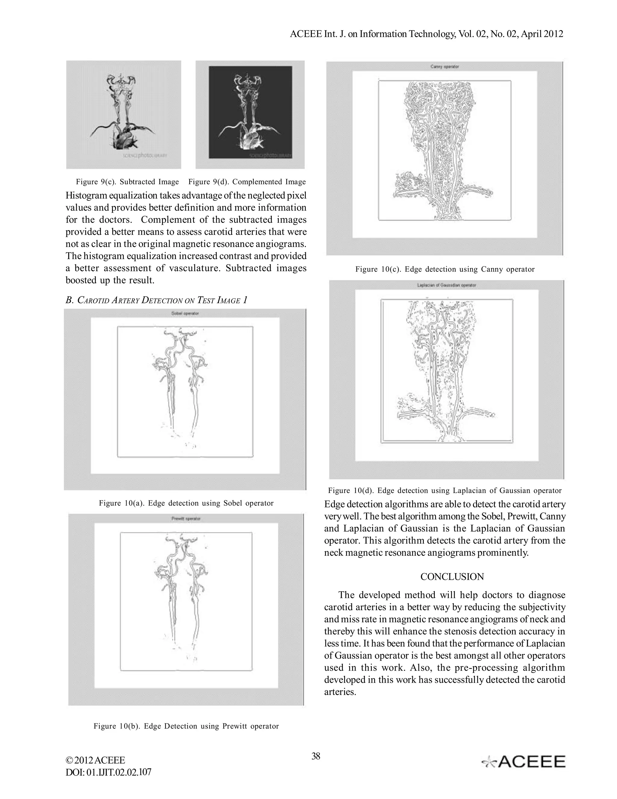 ACEEE Int. J. on Information Technology, Vol. 02, No. 02, April 2012




  Figure 9(c). Subtracted Image   Figure 9(d). Complemented Image
Histogram equalization takes advantage of the neglected pixel
values and provides better definition and more information
for the doctors. Complement of the subtracted images
provided a better means to assess carotid arteries that were
not as clear in the original magnetic resonance angiograms.
The histogram equalization increased contrast and provided
a better assessment of vasculature. Subtracted images                            Figure 10(c). Edge detection using Canny operator
boosted up the result.
B. CAROTID A RTERY DETECTION ON TEST IMAGE 1




                                                                          Figure 10(d). Edge detection using Laplacian of Gaussian operator
        Figure 10(a). Edge detection using Sobel operator                Edge detection algorithms are able to detect the carotid artery
                                                                         very well. The best algorithm among the Sobel, Prewitt, Canny
                                                                         and Laplacian of Gaussian is the Laplacian of Gaussian
                                                                         operator. This algorithm detects the carotid artery from the
                                                                         neck magnetic resonance angiograms prominently.

                                                                                                   CONCLUSION
                                                                             The developed method will help doctors to diagnose
                                                                         carotid arteries in a better way by reducing the subjectivity
                                                                         and miss rate in magnetic resonance angiograms of neck and
                                                                         thereby this will enhance the stenosis detection accuracy in
                                                                         less time. It has been found that the performance of Laplacian
                                                                         of Gaussian operator is the best amongst all other operators
                                                                         used in this work. Also, the pre-processing algorithm
                                                                         developed in this work has successfully detected the carotid
                                                                         arteries.


       Figure 10(b). Edge Detection using Prewitt operator



© 2012 ACEEE                                                        38
DOI: 01.IJIT.02.02.107
 