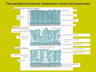 Патоморфологические изменения слизистой кишечника
    Нормальная толстая кишка
                                                        Эпителий

                                                        Lamina propria
       Слизистая
       оболочка
                                                    оболочка слизистой


                                                    Подслизистая
   Язвенные колиты                        изъязвление
            Истощение
   бокаловидных клеток

                                                         искривленные крипты
        криптогенный
             абсцесс
                                                           воспаление Lamina
                                                           propria
                                                         Нормальная подслизистая
                           очаговое воспаление
    Болезнь Крона          Lamina propria                редкий криптогенный абсцесс

                                                         запасы бокаловидных клеток
    крипты нормальной
               формы

        грануломы

                                                        воспаление вовлекает
                                                        подслизистую
 