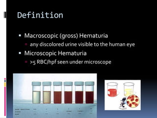 Definition
 Macroscopic (gross) Hematuria
 any discolored urine visible to the human eye
 Microscopic Hematuria
 >5 RBC/hpf seen under microscope
 