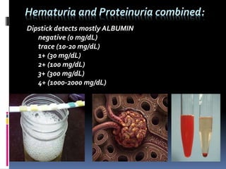 Hematuria and Proteinuria combined:
Dipstick detects mostly ALBUMIN
negative (0 mg/dL)
trace (10-20 mg/dL)
1+ (30 mg/dL)
2+ (100 mg/dL)
3+ (300 mg/dL)
4+ (1000-2000 mg/dL)
 