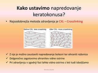 Kako ustavimo napredovanje
keratokonusa?
• Najsodobnejša metoda zdravljenja je CXL – Crosslinking
 Z njo je možno zaustaviti napredovanje bolezni ter ohraniti roženico
 Dolgoročno zagotovimo ohranitev vidne ostrine
 Pri zdravljenju v zgodnji fazi lahko vidno ostrino z leti tudi izboljšamo
Morela okulisti
 