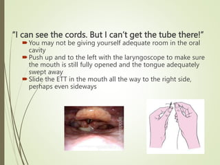 “I can see the cords. But I can’t get the tube there!”
You may not be giving yourself adequate room in the oral
cavity
Push up and to the left with the laryngoscope to make sure
the mouth is still fully opened and the tongue adequately
swept away
Slide the ETT in the mouth all the way to the right side,
perhaps even sideways
 