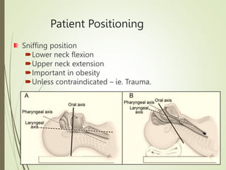 Patient Positioning
Sniffing position
Lower neck flexion
Upper neck extension
Important in obesity
Unless contraindicated – ie. Trauma.
 