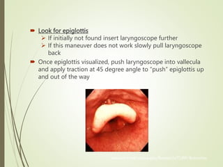  Look for epiglottis
 If initially not found insert laryngoscope further
 If this maneuver does not work slowly pull laryngoscope
back
 Once epiglottis visualized, push laryngoscope into vallecula
and apply traction at 45 degree angle to “push” epiglottis up
and out of the way
www.int-med.uiowa.edu/Research/TLIRP/Bronchos
 