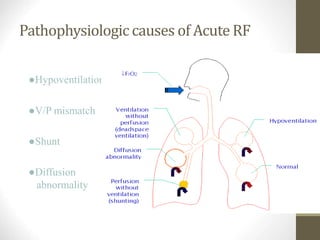 Pathophysiologic causes of Acute RF
●Hypoventilation
●V/P mismatch
●Shunt
●Diffusion
abnormality
 