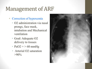 Management of ARF
• Correction of hypoxemia
• O2 administration via nasal
prongs, face mask,
intubation and Mechanical
ventilation
• Goal: Adequate O2
delivery to tissues
• PaO2 = > 60 mmHg
• Arterial O2 saturation
>90%
 