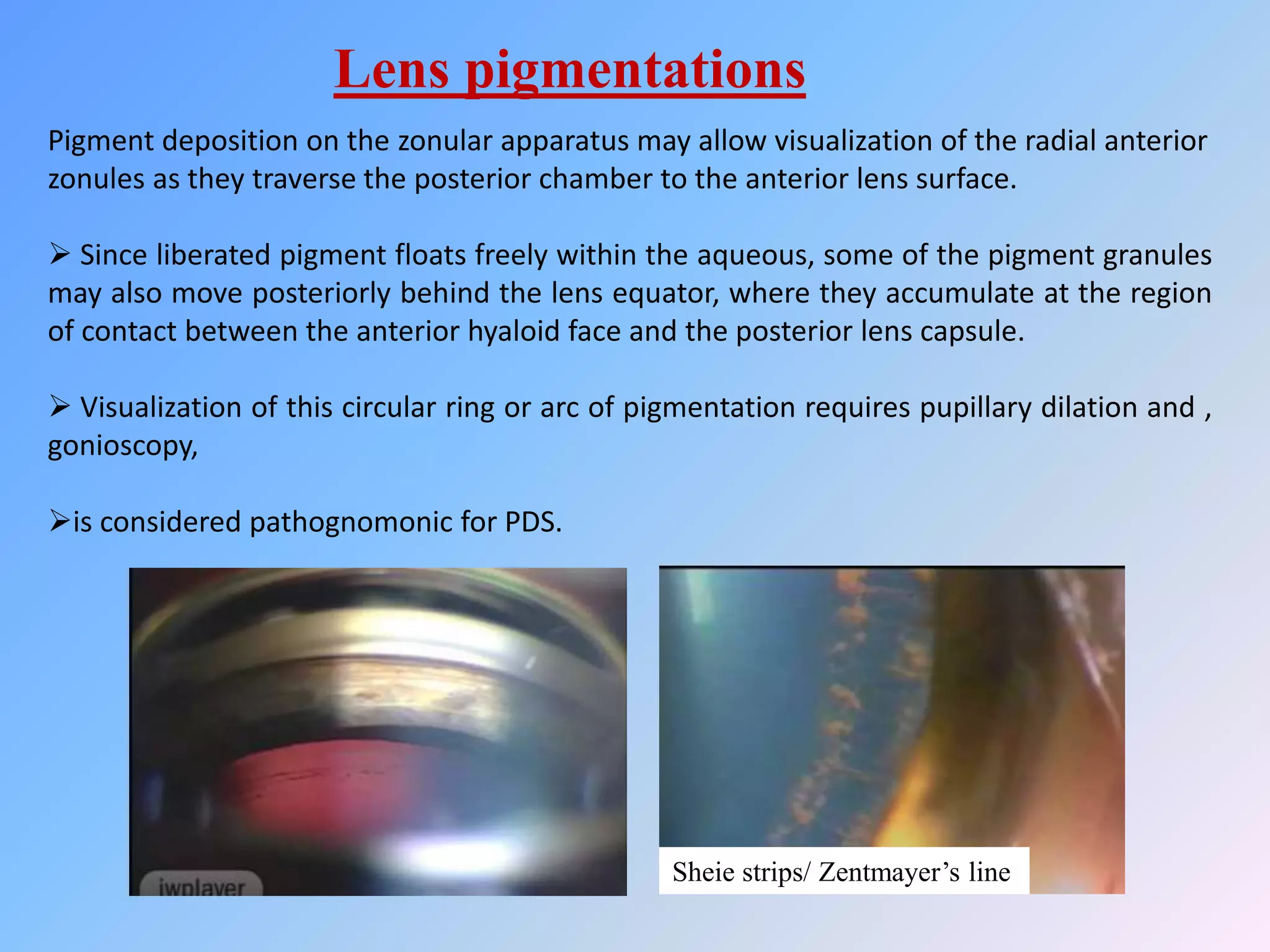 pigment dispersion syndrome by Hala Fathi Hannot