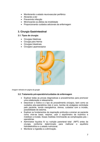 • Monitorando o estado neurovascular periférico
• Aliviando a dor
• Prevenindo infecção
• Minimizando os efeitos da imobilidade
• Proporcionando cuidados adicionais de enfermagem
3. Cirurgia Gastrintestinal
3.1. Tipos de cirurgia:
• Cirurgias Gástricas
• Cirurgia para Hernia
• Cirurgias Intestinais
• Cirurgias Laparoscopica
Imagem retirada em pagina da google
3.2. Tratamento pré-operatório/cuidados de enfermagem
• Explicar todas as provas diagnosticas e procedimentos para promover
uma colaboração e relaxamento.
• Descrever o motivo e o tipo do procedimento cirúrgico, bem como os
cuidados pós-operatórios (isto é soro, bomba de analgesia controlada
pelo paciente, sonda nasogástrica, drenos, cuidados com a incisão,
possibilidade de ostomia.
• Explicar os fundamentos da respiração profunda e ensinar ao paciente
como virar-se tossir, respirar, usar o espirômetro de incentivo e
mobilizar a incisão. Essas medidas minimizarão as complicações pós –
operatórias
• Administrar líquidos IV ou nutrição parenteral total (NPT) antes da
cirurgia, conforme determinado para melhorar o equilíbrio
hidroeletrolítico e o estado nutricional.
• Monitorar a ingestão e a eliminação.
7
 