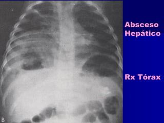 Absceso 
Hepático 
Rx Tórax 
 