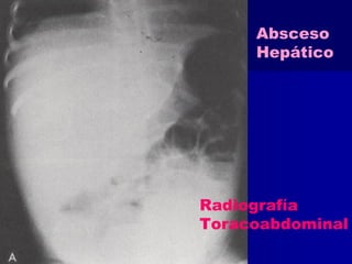Absceso 
Hepático 
Radiografía 
Toracoabdominal 
 