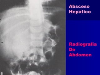 Absceso 
Hepático 
Radiografía 
De 
Abdomen 
 