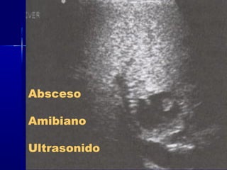 Absceso 
Amibiano 
Ultrasonido 
 