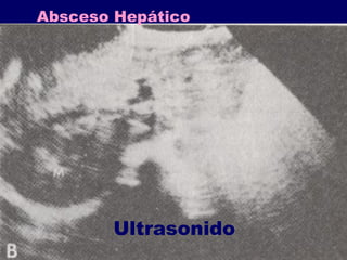 Absceso Hepático 
Ultrasonido 
 