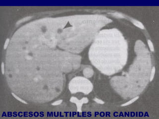 ABSC ESOS MUL TIPLES POR CANDIDA 
 