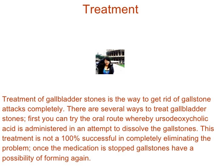 Acid Reflux Caused by Gallbladder Stones: A Misconception