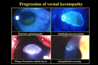 Progression of vernal keratopathy
Punctate epitheliopathy Epithelial macroerosions
Plaque formation (shield ulcer) Subepithelial scarring
 