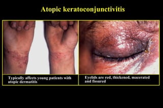 Atopic keratoconjunctivitis
Typically affects young patients with
atopic dermatitis
Eyelids are red, thickened, macerated
and fissured
 