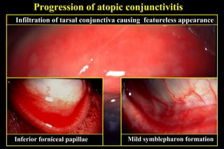 Progression of atopic conjunctivitis
Infiltration of tarsal conjunctiva causing featureless appearance
Inferior forniceal papillae Mild symblepharon formation
 