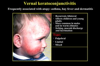 Vernal keratoconjunctivitis
• Affects children and young
adults
• More common in males
and in warm climates
• Itching, mucoid discharge
and lacrimation
• Palpebral
Types
• Limbal
• Mixed
• Recurrent, bilateral
Frequently associated with atopy: asthma, hay fever and dermatitis
 