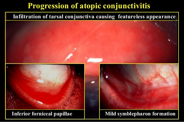 Allergic conjunctivitis