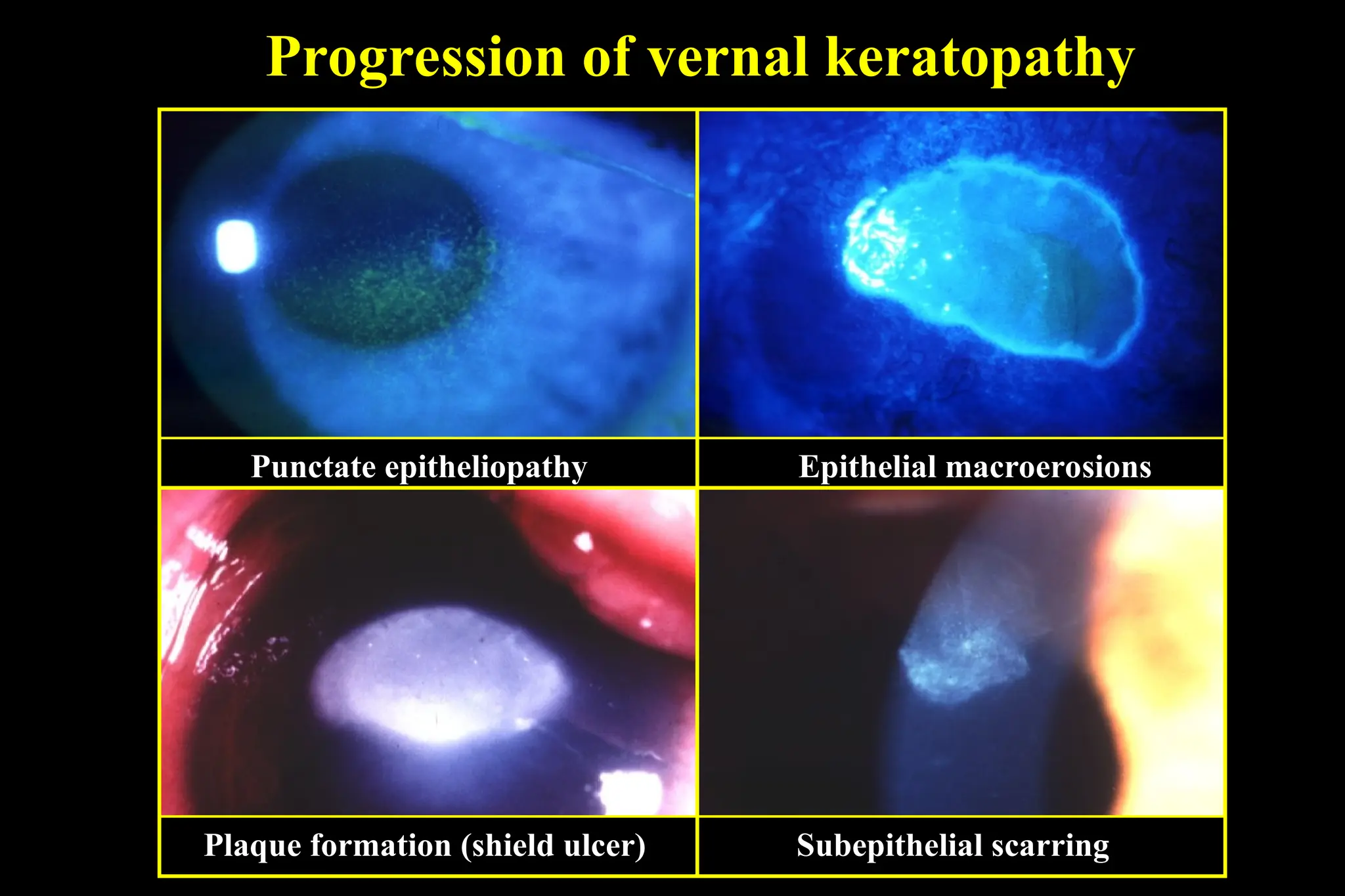 Progression of vernal keratopathy
Punctate epitheliopathy Epithelial macroerosions
Plaque formation (shield ulcer) Subepithelial scarring
 