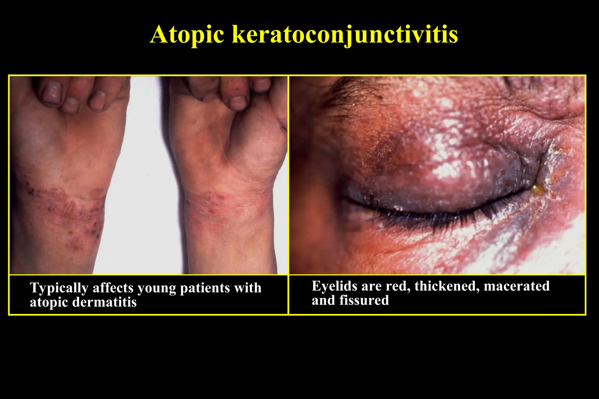 Atopic keratoconjunctivitis
Typically affects young patients with
atopic dermatitis
Eyelids are red, thickened, macerated
and fissured
 