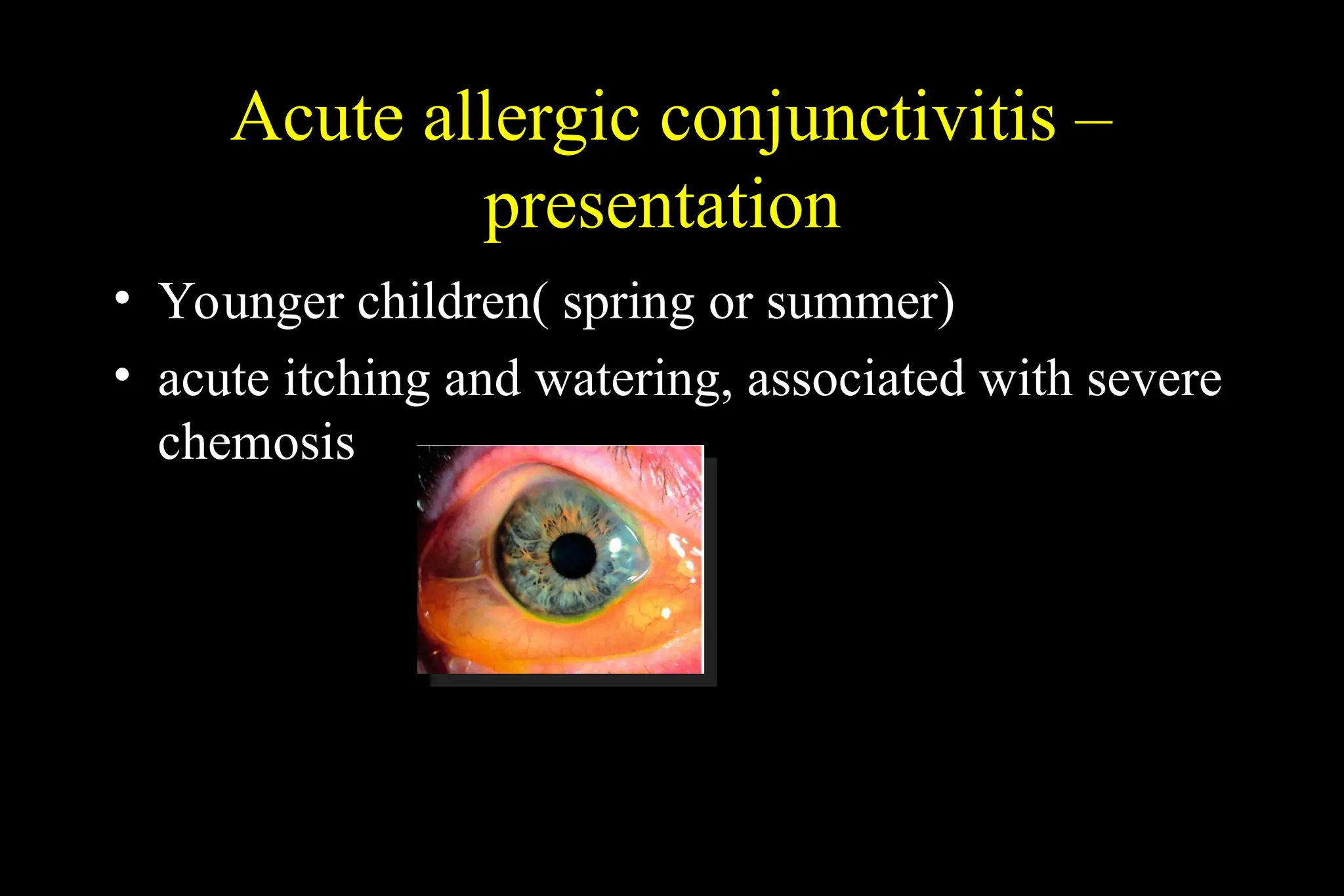 Acute allergic conjunctivitis –
presentation
• Younger children( spring or summer)
• acute itching and watering, associated with severe
chemosis
 