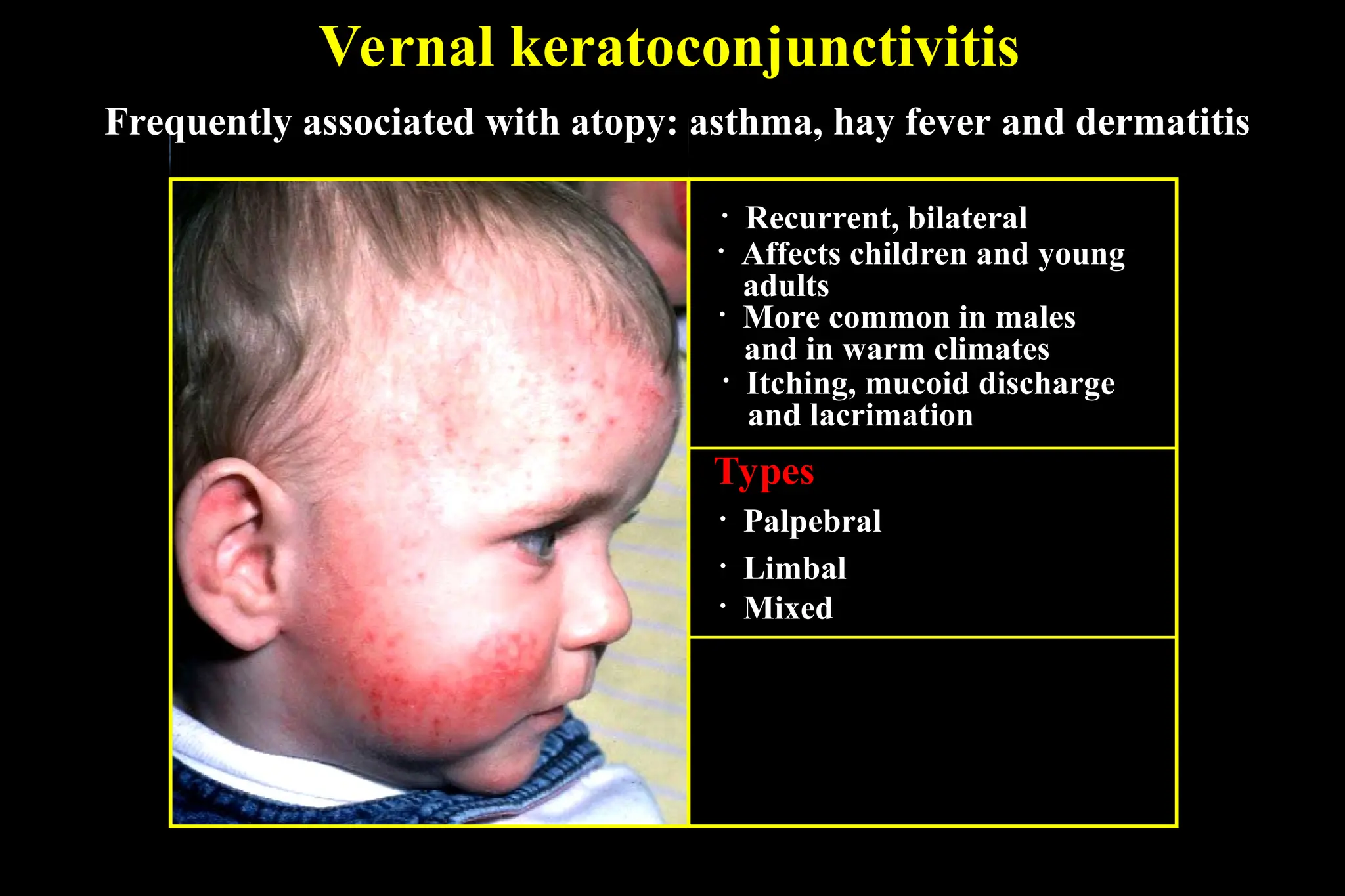 Vernal keratoconjunctivitis
• Affects children and young
adults
• More common in males
and in warm climates
• Itching, mucoid discharge
and lacrimation
• Palpebral
Types
• Limbal
• Mixed
• Recurrent, bilateral
Frequently associated with atopy: asthma, hay fever and dermatitis
 