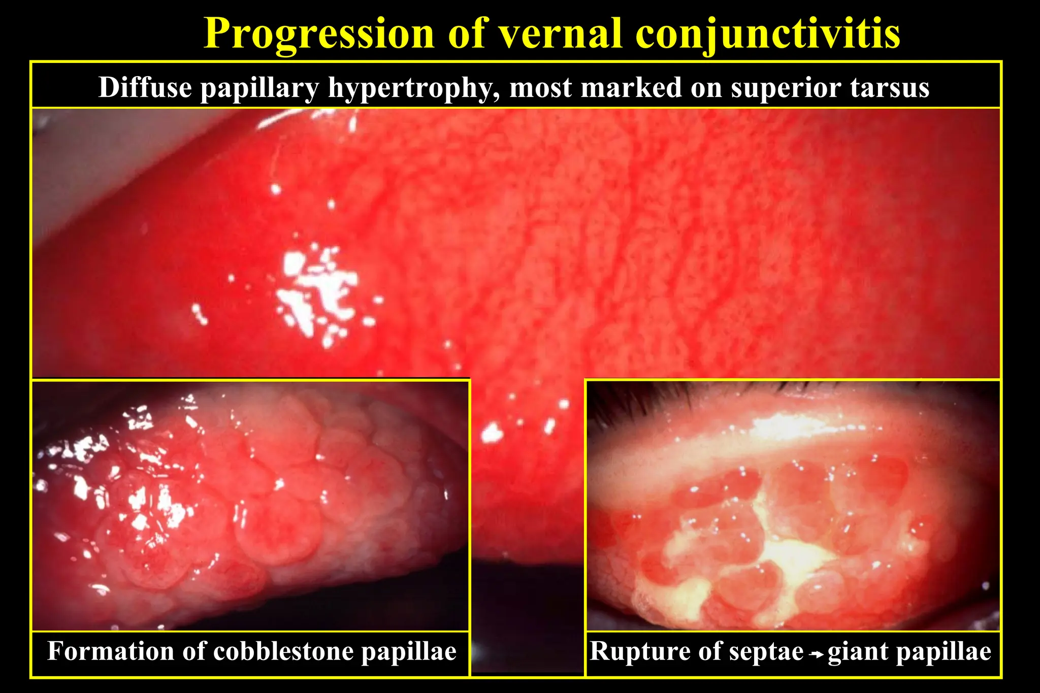 Progression of vernal conjunctivitis
Diffuse papillary hypertrophy, most marked on superior tarsus
Formation of cobblestone papillae Rupture of septae - giant papillae
 