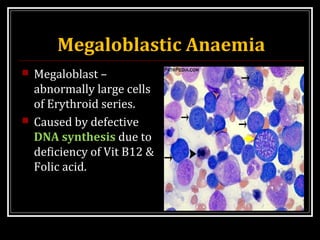 Megaloblastic Anaemia
 Megaloblast –
abnormally large cells
of Erythroid series.
 Caused by defective
DNA synthesis due to
deficiency of Vit B12 &
Folic acid.
 