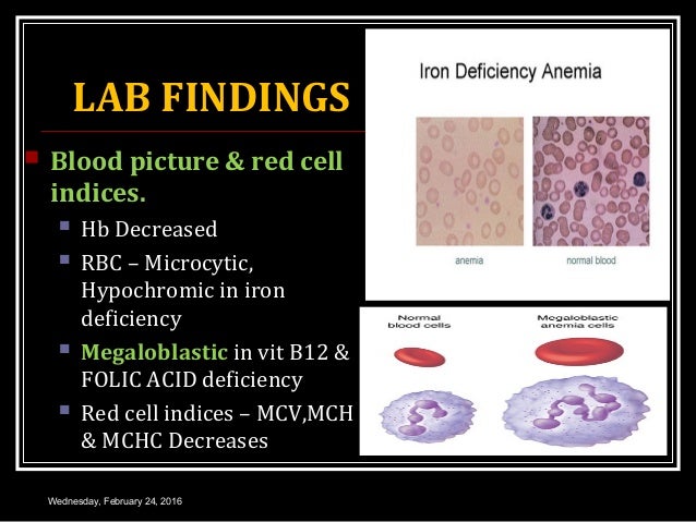 iron deficiency anemia Iron deficiency anemia: a common form of nutritional disorder, iron deficiency results in anemia as iron is necessary to make hemoglobin, key molecule in red blood cells responsible for the transport of oxygen in iron deficiency anemia, the red cells appear abnormal and are unusually small. iron deficiency anemia Iron deficiency anemia: a common form of nutritional disorder, iron deficiency results in anemia as iron is necessary to make hemoglobin, key molecule in red blood cells responsible for the transport of oxygen in iron deficiency anemia, the red cells appear abnormal and are unusually small.