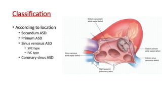 10 – Atrial septal defects Zeeshan.pptx