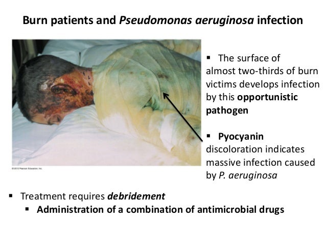 Pseudomonas infection - Wikipedia