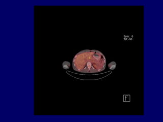 Mean of R increases to 3