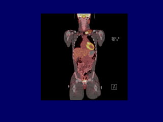 Mean of S increases to 7.5Relevance to Clinical Trials: Stage MigrationImproved detection of illness leads to the movement of people from the set of healthy to the set of unhealthyExample: Increased sensitivity of PET scans in lymphomaMoves “early” stage to advanced stage
