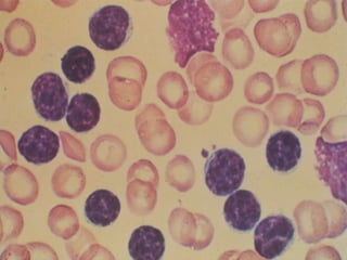 Microvessel Density in DLBCLCardesa-Salzmann et al, Haematol 2011 (e-pub ahead of print)