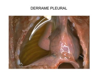 DERRAME PLEURAL
 