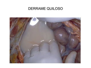 DERRAME QUILOSO
 
