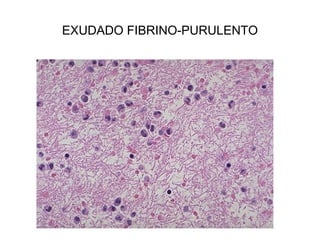 EXUDADO FIBRINO-PURULENTO
 