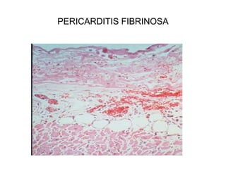 PERICARDITIS FIBRINOSA
 