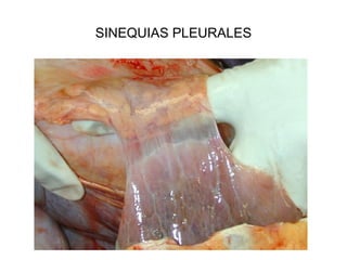 SINEQUIAS PLEURALES
 