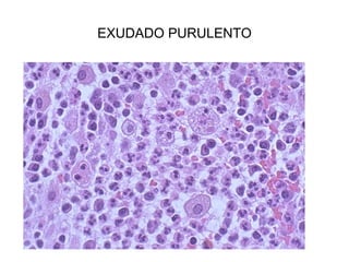 EXUDADO PURULENTO
 