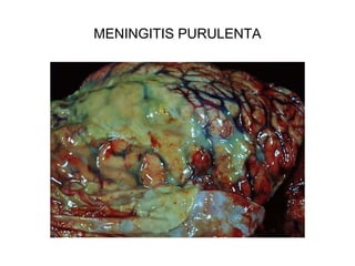 MENINGITIS PURULENTA
 