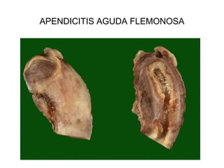 APENDICITIS AGUDA FLEMONOSA
 