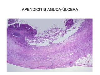 APENDICITIS AGUDA-ÚLCERA
 